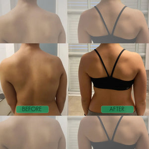 Postrixmer Posture Corrector For Scoliosis