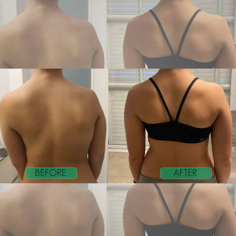 Postrixmer Posture Corrector For Scoliosis